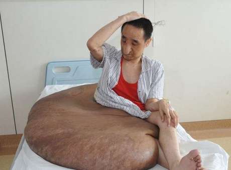 Chinês tem tumor removidodas pernas