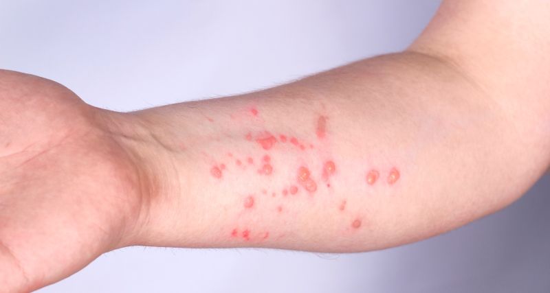 mpox