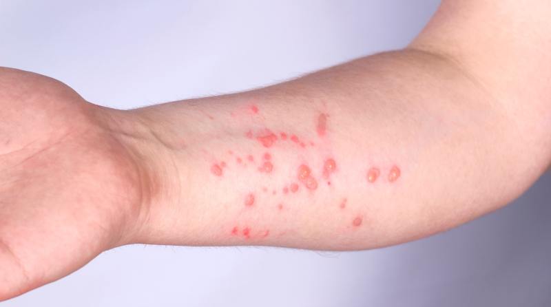 MPOX sarampo
